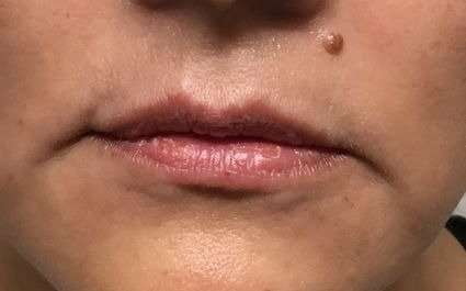 Fillers Before & After Patient #13237