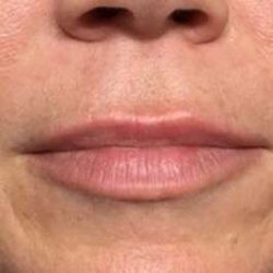 Fillers Before & After Patient #13234