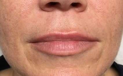 Fillers Before & After Patient #13234