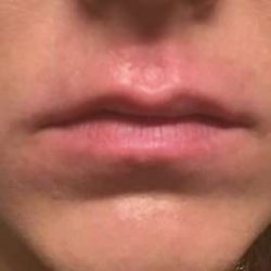 Fillers Before & After Patient #13231