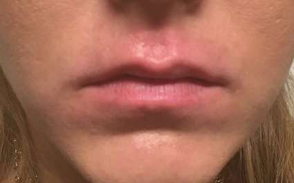 Fillers Before & After Patient #13231