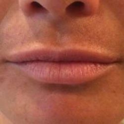 Fillers Before & After Patient #13228