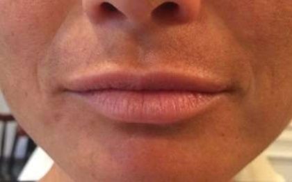 Fillers Before & After Patient #13228