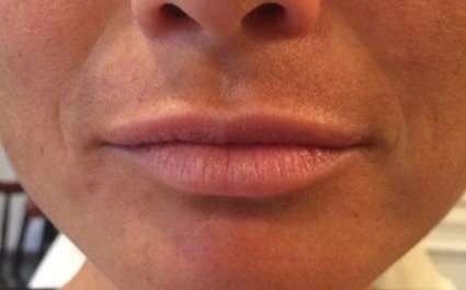 Fillers Before & After Patient #13228