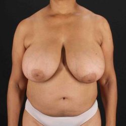 Breast Reconstruction Before & After Patient #10914