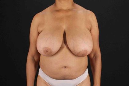 Breast Reconstruction Before & After Patient #10914