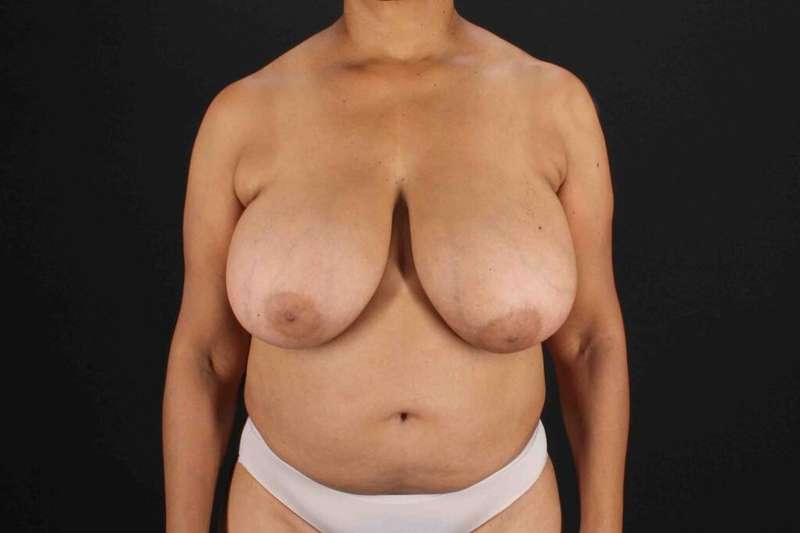 Breast Reconstruction Before & After Patient #10914