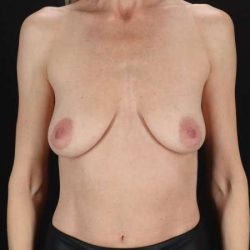 Breast Augmentation with Implants Before & After Patient #10903