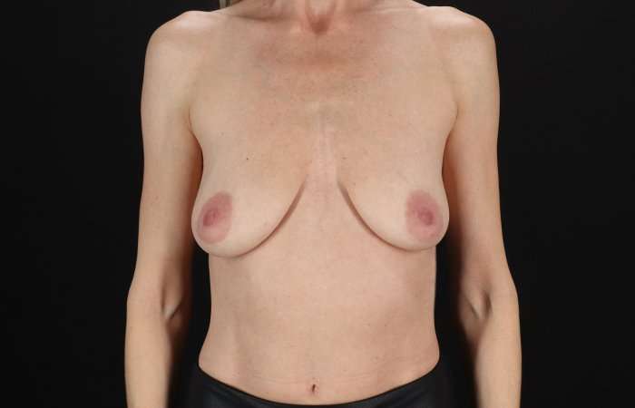 Breast Augmentation with Implants Before & After Patient #10903