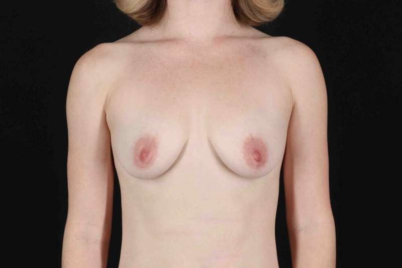 Breast Augmentation with Implants Before & After Patient #10892
