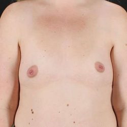 Breast Augmentation with Implants Before & After Patient #10870