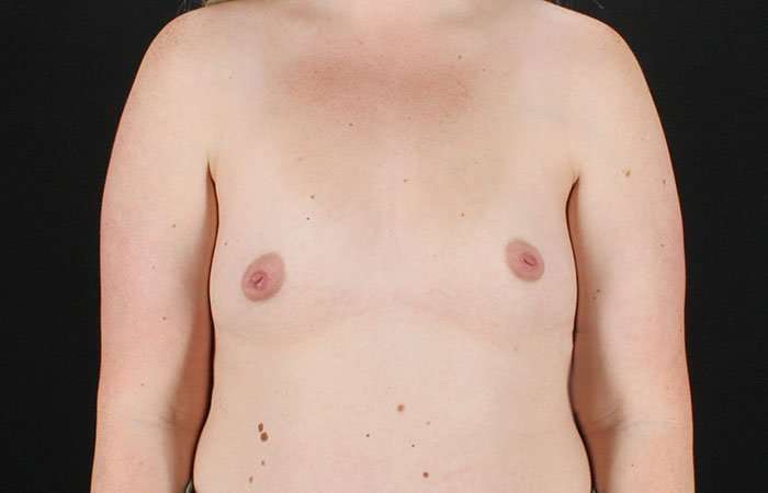 Breast Augmentation with Implants Before & After Patient #10870