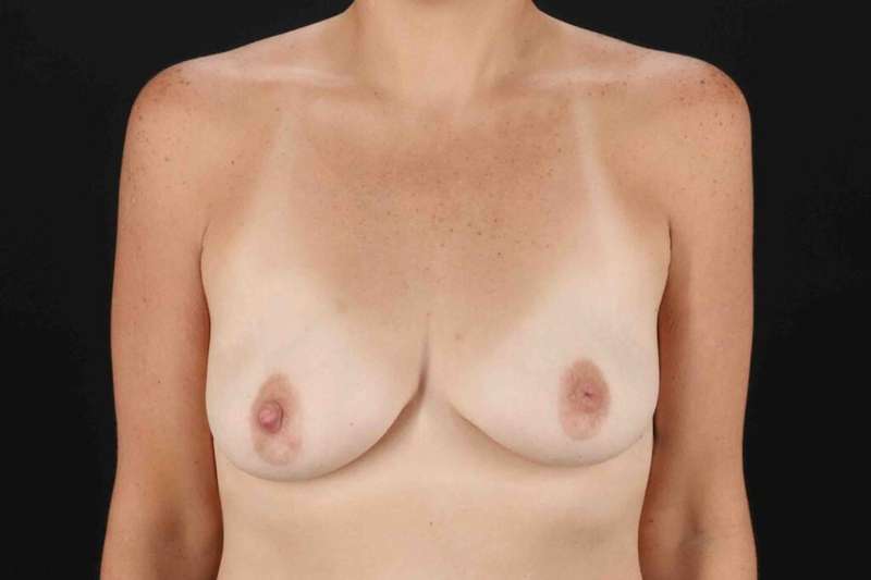 Breast Augmentation with Implants Before & After Patient #10881