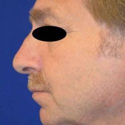 Chin Implant Before & After Patient #13670