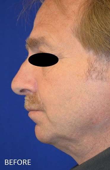 Chin Implant Before & After Patient #13670