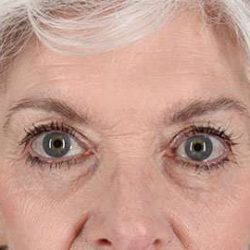 Blepharoplasty (Eyelid Surgery) Before & After Patient #13667