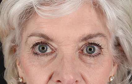 Blepharoplasty (Eyelid Surgery) Before & After Patient #13667