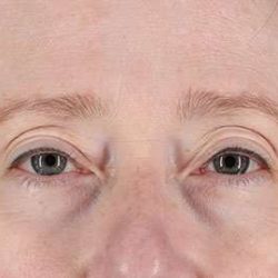 Blepharoplasty (Eyelid Surgery) Before & After Patient #13664