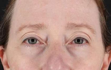 Blepharoplasty (Eyelid Surgery) Before & After Patient #13664
