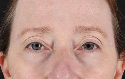 Blepharoplasty (Eyelid Surgery) Before & After Patient #13664