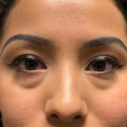Blepharoplasty (Eyelid Surgery) Before & After Patient #13661