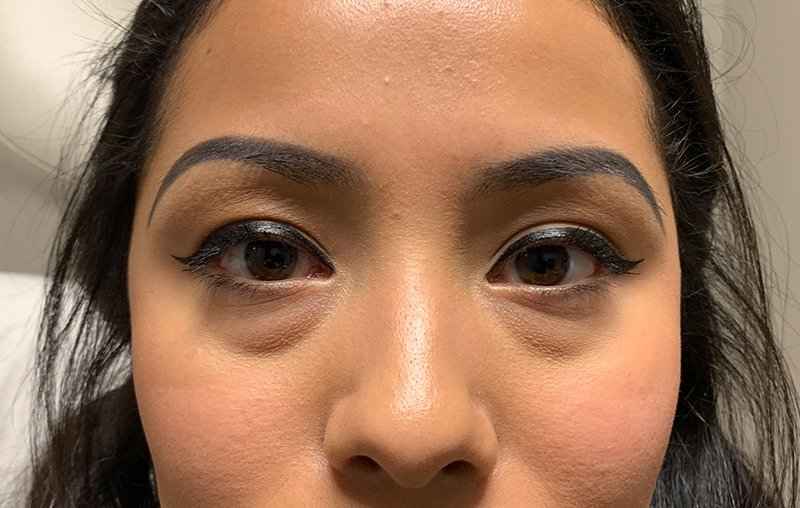 Blepharoplasty (Eyelid Surgery) Before & After Patient #13661