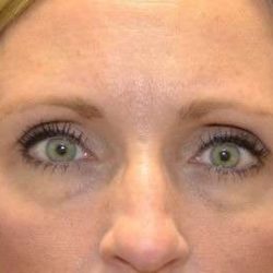 Blepharoplasty (Eyelid Surgery) Before & After Patient #13658