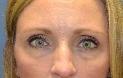 Blepharoplasty (Eyelid Surgery) Before & After Patient #13658