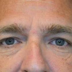 Blepharoplasty (Eyelid Surgery) Before & After Patient #13655