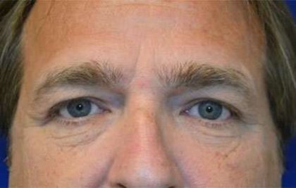 Blepharoplasty (Eyelid Surgery) Before & After Patient #13655