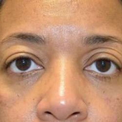 Blepharoplasty (Eyelid Surgery) Before & After Patient #13652