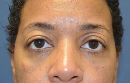 Blepharoplasty (Eyelid Surgery) Before & After Patient #13652