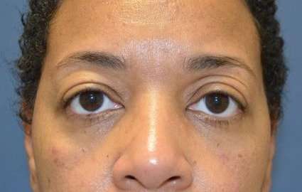 Blepharoplasty (Eyelid Surgery) Before & After Patient #13652