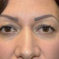 Blepharoplasty (Eyelid Surgery) Before & After Patient #13649