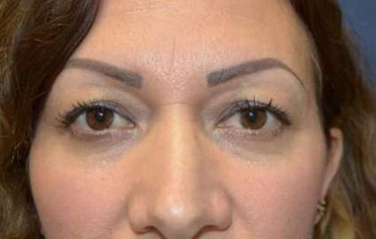 Blepharoplasty (Eyelid Surgery) Before & After Patient #13649