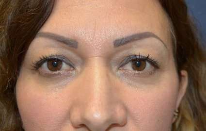 Blepharoplasty (Eyelid Surgery) Before & After Patient #13649