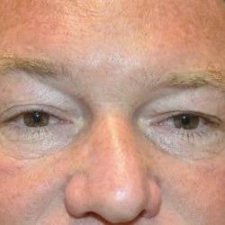 Blepharoplasty (Eyelid Surgery) Before & After Patient #13646