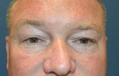Blepharoplasty (Eyelid Surgery) Before & After Patient #13646