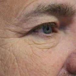 Blepharoplasty (Eyelid Surgery) Before & After Patient #13643