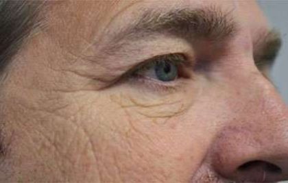 Blepharoplasty (Eyelid Surgery) Before & After Patient #13643