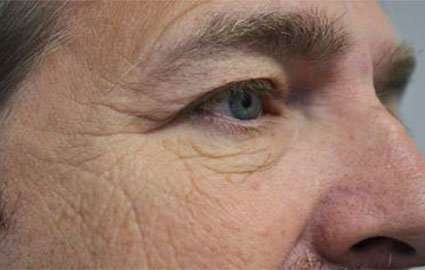 Blepharoplasty (Eyelid Surgery) Before & After Patient #13643