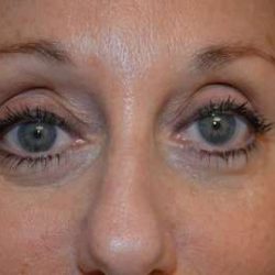 Blepharoplasty (Eyelid Surgery) Before & After Patient #13640