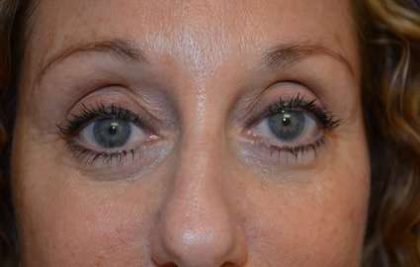 Blepharoplasty (Eyelid Surgery) Before & After Patient #13640