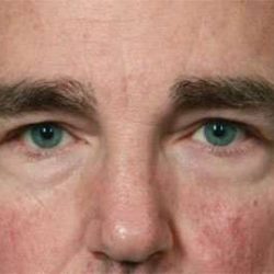 Blepharoplasty (Eyelid Surgery) Before & After Patient #13637