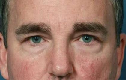 Blepharoplasty (Eyelid Surgery) Before & After Patient #13637