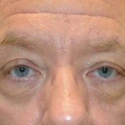 Blepharoplasty (Eyelid Surgery) Before & After Patient #13634