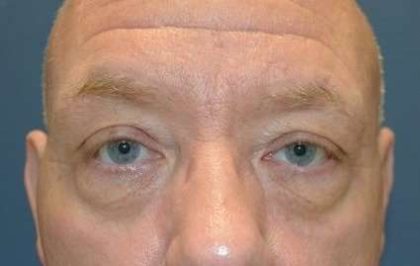 Blepharoplasty (Eyelid Surgery) Before & After Patient #13634