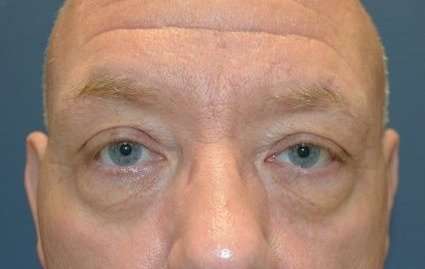 Blepharoplasty (Eyelid Surgery) Before & After Patient #13634