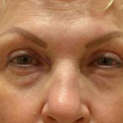 Blepharoplasty (Eyelid Surgery) Before & After Patient #13631