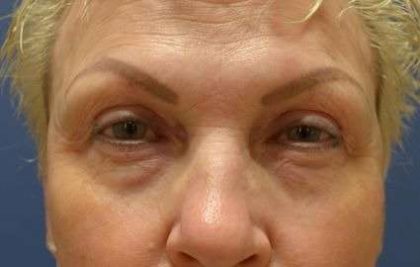 Blepharoplasty (Eyelid Surgery) Before & After Patient #13631